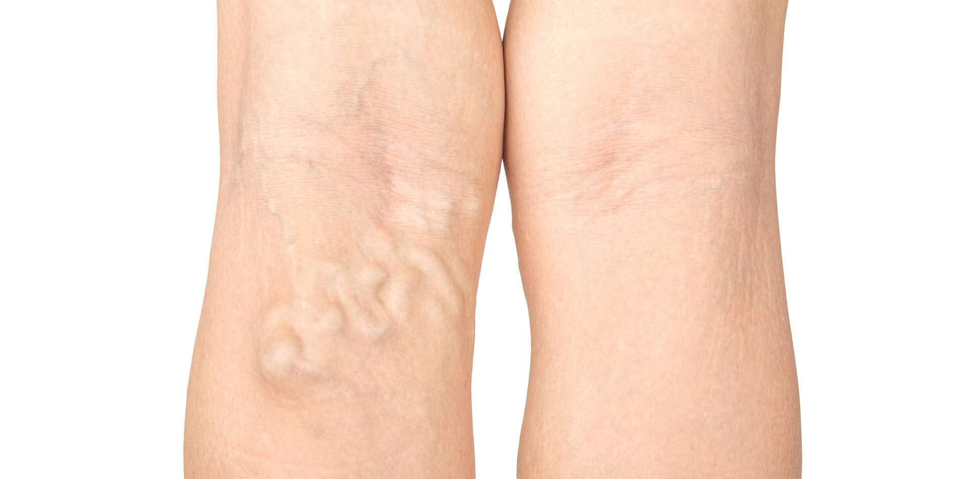 下肢静脈瘤レーザー手術